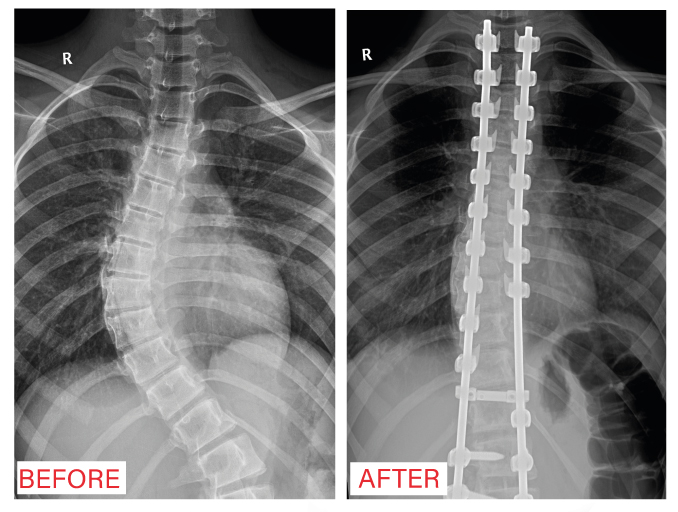 انقاذ طفلة كانت تعاني من أعوجاج بالعمود الفقري  في مستشفى المواساة بالرياض